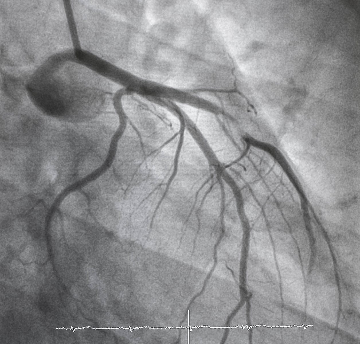 Coronary Artery Disease OrbusNeich