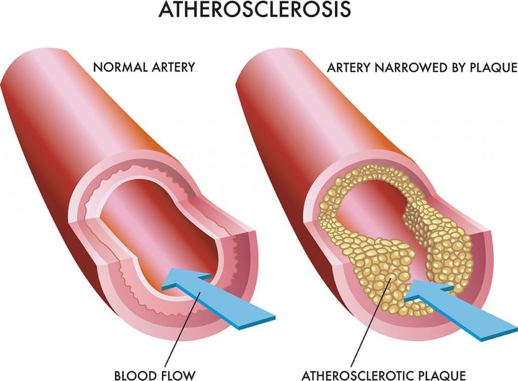 Gejala dan penyebab penyakit arteri koronari