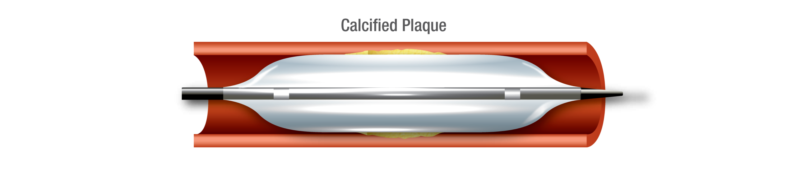 Calcified plaque cross-section with non-compliant balloon
