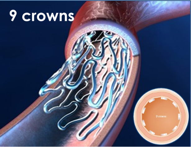 9 crown stent deployed in vessel illustration