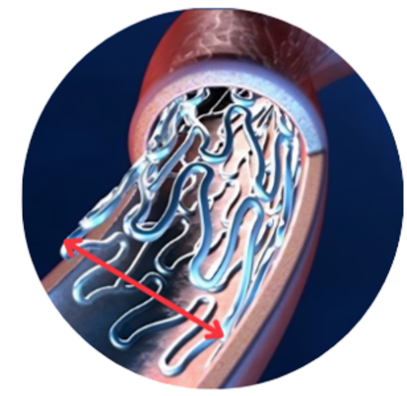 Stent expansion in tapered vessel illustration